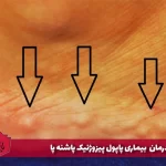 علائم، علل و درمان بیماری پاپول پیزوژنیک پاشنه پا