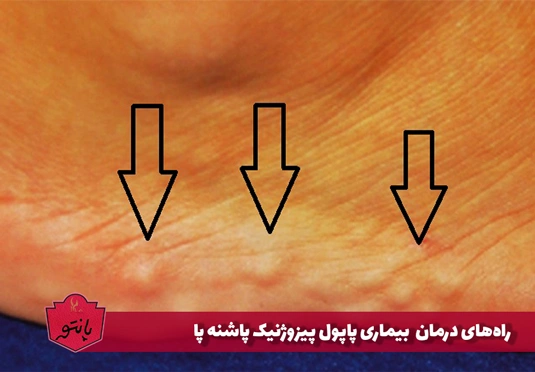 علائم، علل و درمان بیماری پاپول پیزوژنیک پاشنه پا